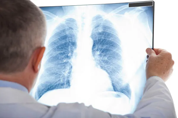 Pulmonx Co. (NASDAQ:LUNG) CEO Sells $127,700.00 in Stock